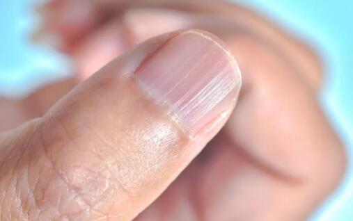 指甲有竖纹是身体的什么信号？身体可能出现状况了，最好要注意