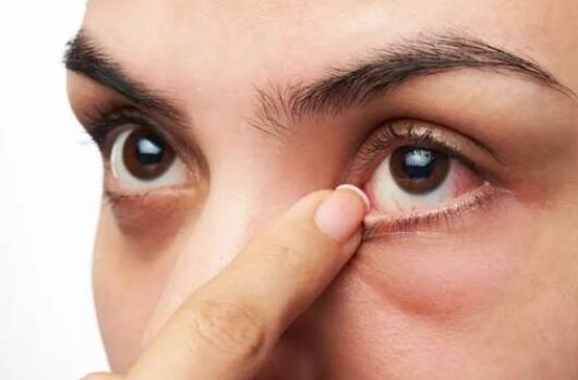 眼睛干涩发痒是什么原因引起的？病理与生活原因都有，患者需根据病因妥善护理